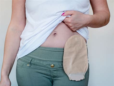 dating with a stoma bag